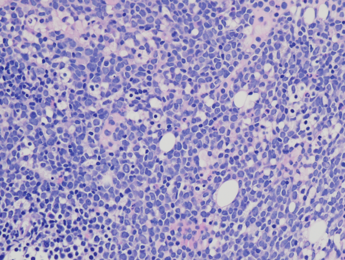 Figure 4: Bone marrow core biopsy with sheets of immature cells (400x magnification).